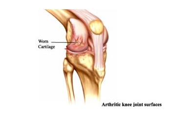 Hormone Promises to Keep Joint Injuries from Causing Long-term Osteoarthritis