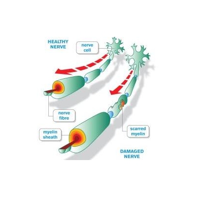 New Multiple Sclerosis Drug has URMC Ties