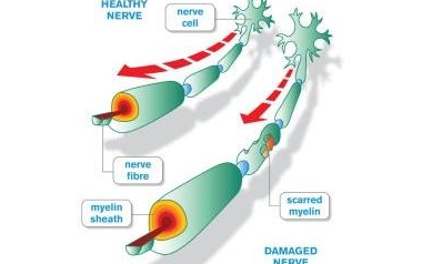 New Multiple Sclerosis Drug has URMC Ties