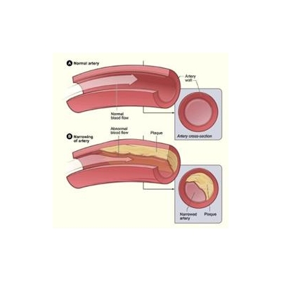 Research Reveals How Blood Flow Force Protects Blood Vessels