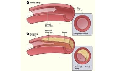 Research Reveals How Blood Flow Force Protects Blood Vessels