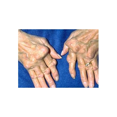 As Hopes for Early Arthritis Detection Improve, Local Clinic Acts Fast to Save Joints