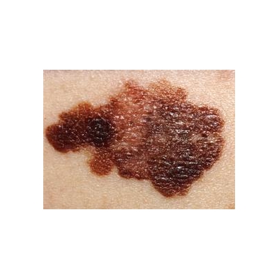 Dermatologists Offer Free Skin Cancer Checks May 22