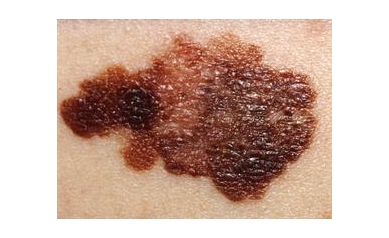 Dermatologists Offer Free Skin Cancer Checks May 22