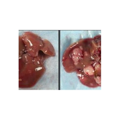 Androgen Receptor May Explain Male Dominance in Liver Cancer