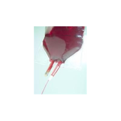 Filtering Donor Blood Reduces Heart, Lung Complications