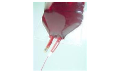 Filtering Donor Blood Reduces Heart, Lung Complications