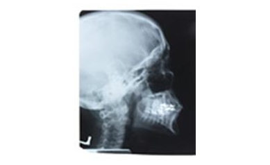 Decades after Childhood Radiation, Thyroid Cancer a Concern
