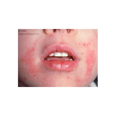 Study Reveals Major Shift in How Eczema Develops