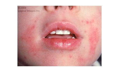 Study Reveals Major Shift in How Eczema Develops
