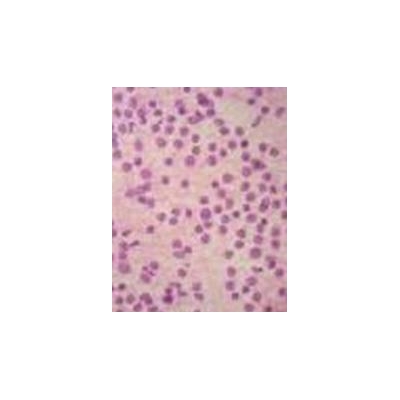 Scientists Look to Immune System to Handle Follicular Lymphoma