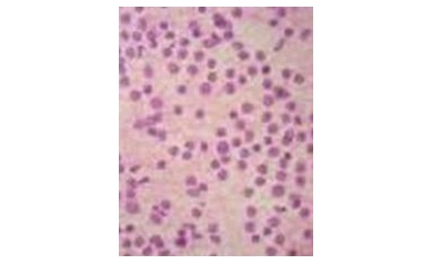 Scientists Look to Immune System to Handle Follicular Lymphoma