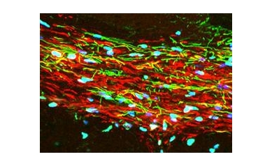 Precision with Stem Cells a Step Forward for Treating M.S., Other Diseases