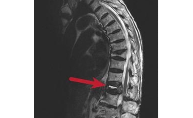99-year-old Woman Regains Mobility Following Spinal Procedures