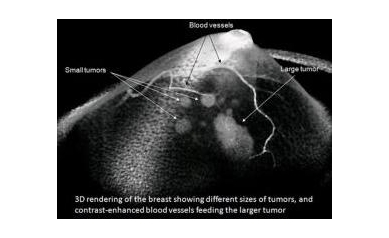 Koning Breast Scanner Receives European Regulatory Approval