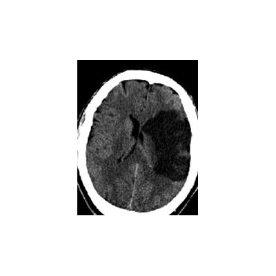 Local Health Systems Collaborate on Pilot Program to Prevent, Treat Stroke