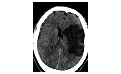 Local Health Systems Collaborate on Pilot Program to Prevent, Treat Stroke