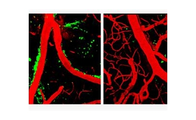 Alzheimer’s Gene Causes Brain’s Blood Vessels to Leak, Die