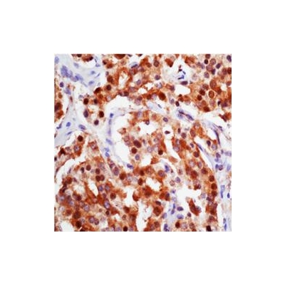 A New Route for Tackling Treatment-Resistant Prostate Cancer