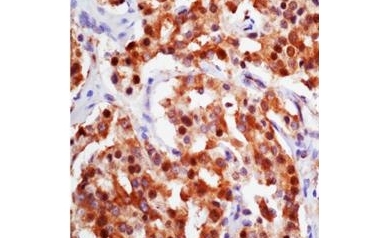 A New Route for Tackling Treatment-Resistant Prostate Cancer