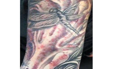 In Rochester, a Tale of Tainted Tattoos