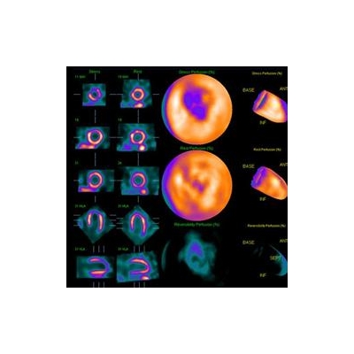 New Nuclear Imaging System at URMC Hastens Diagnosis of Heart Disease