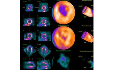 New Nuclear Imaging System at URMC Hastens Diagnosis of Heart Disease