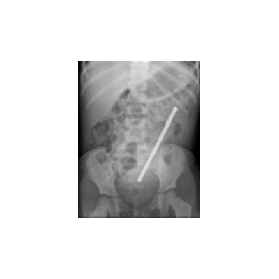 Magnet Ingestion Injuries on the Rise Among Children