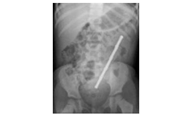 Magnet Ingestion Injuries on the Rise Among Children