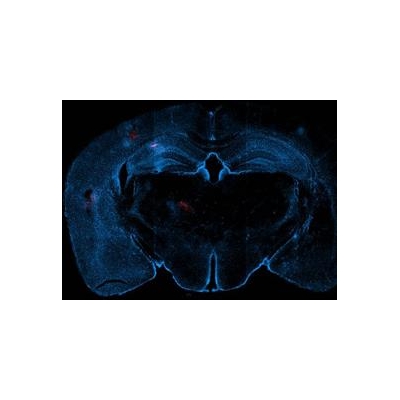 Study Details Brain Damage Triggered by Mini-Strokes