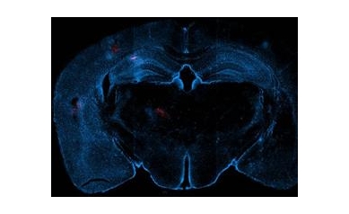 Study Details Brain Damage Triggered by Mini-Strokes