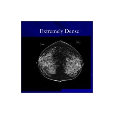 NY Law: Following Mammography, Physicians Must Notify of Breast Density