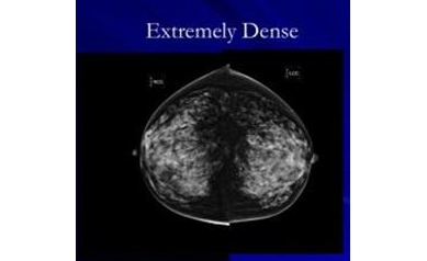 NY Law: Following Mammography, Physicians Must Notify of Breast Density