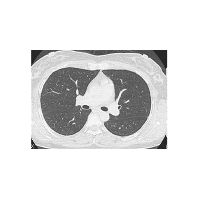 URMC Opens Clinic, Initiates Research on Rare Lung Disease in Women