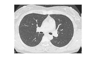 URMC Opens Clinic, Initiates Research on Rare Lung Disease in Women