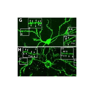 Scientists Coax Brain to Regenerate Cells Lost in Huntington’s Disease