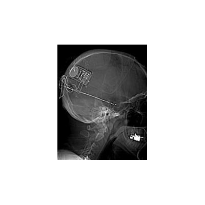 URMC Plays Role in New Epilepsy Technology
