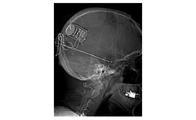 URMC Plays Role in New Epilepsy Technology