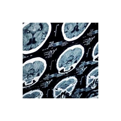 UR Medicine Helps Forge National Stroke Care Guidelines