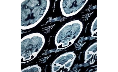 UR Medicine Helps Forge National Stroke Care Guidelines