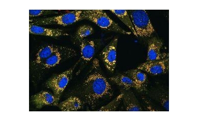 Gene Discovery Links Cancer Cell ‘Recycling’ System to Potential New Therapy