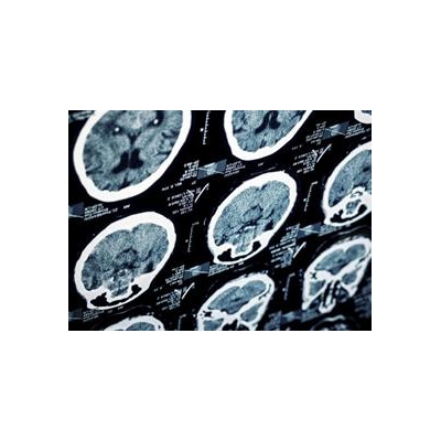 $2 Million Gift from Fine Family to Support Alzheimer’s Care, Research