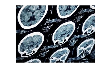 $2 Million Gift from Fine Family to Support Alzheimer’s Care, Research