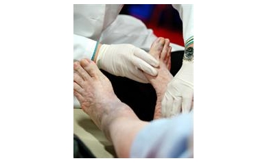 UR Medicine Offers Free Foot Screening for Diabetics