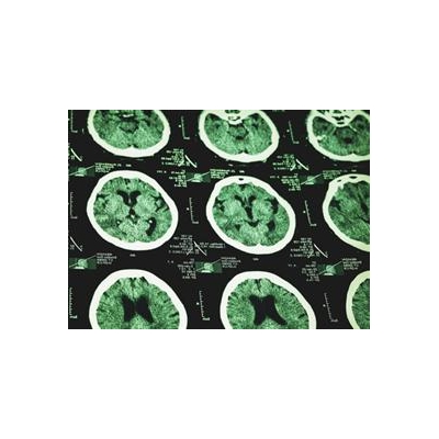 Blows to Head Damage Brain’s ‘Garbage Truck,’ Accelerate Dementia