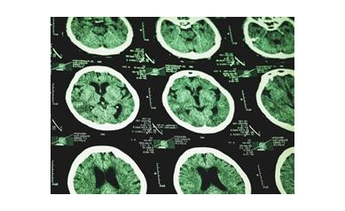Blows to Head Damage Brain’s ‘Garbage Truck,’ Accelerate Dementia
