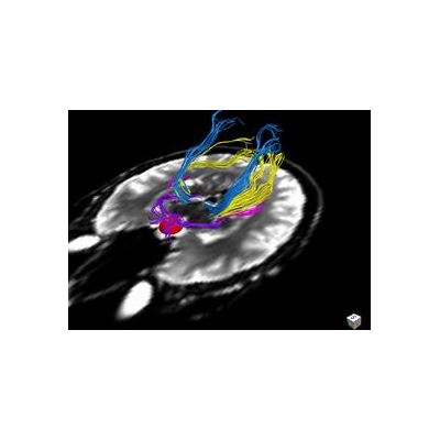 New Technology Helps Predict Vision Recovery After Brain Tumor Surgery