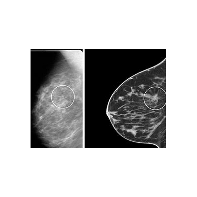 Another URMC Milestone: FDA Approves High-Tech Breast Imaging System