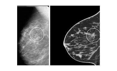 Another URMC Milestone: FDA Approves High-Tech Breast Imaging System