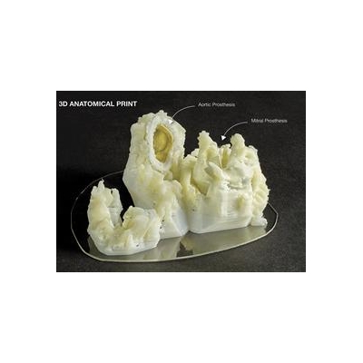 UR Medicine Heart Team Uses 3D Printing to Save Woman’s Life